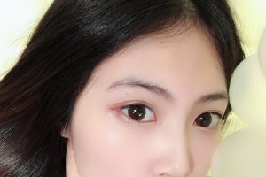 西京醫(yī)院整形外科怎么樣？隆鼻手術(shù)附果圖