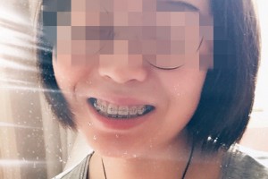 南京市口腔醫(yī)院牙齒矯正果？術(shù)后經(jīng)驗(yàn)分享