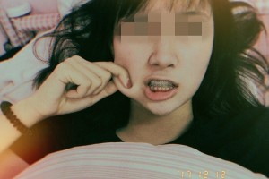 上海交通大學醫(yī)學院附屬第九人民醫(yī)院牙齒矯正附果圖