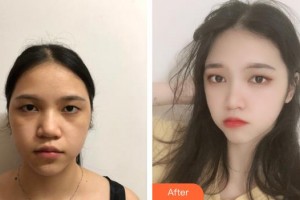 郴州曹家易麗醫(yī)療美容門(mén)診部李曉東整形價(jià)格表附去痘印痘坑案例展示