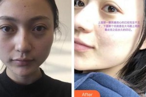 郴州瑞瀾醫(yī)療美容醫(yī)院趙小中主診醫(yī)師整形價格表附激光祛斑案例展示