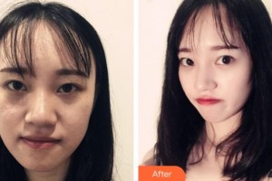 郴州愛(ài)思特醫(yī)療美容醫(yī)院黃見(jiàn)勇整形價(jià)格表附鼻部綜合案例展示