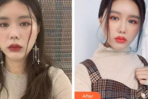 郴州市第四人民醫(yī)院王暉整形價(jià)格表附鼻小柱延長(zhǎng)案例展示