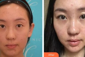 郴州市第四人民醫(yī)院周永生整形價(jià)格表附熱瑪吉案例展示