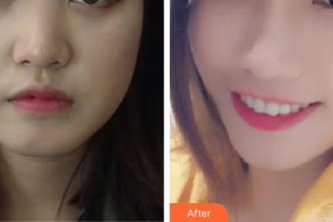 郴州市第四人民醫(yī)院余永斌整形價(jià)格表附埋線提升案例展示