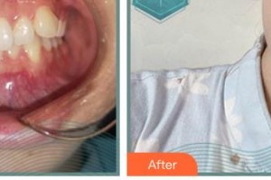 郴州冠華口腔醫(yī)院嚴(yán)國(guó)南整形價(jià)格表附牙齒隱形矯正案例展示