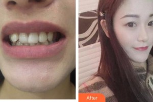 郴州瑞瀾醫(yī)療美容醫(yī)院王莉整形價(jià)格表附牙貼面案例展示