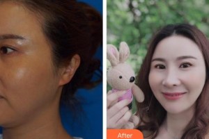 南方醫(yī)院整形美容科高建華整形價格表附射頻緊膚案例展示