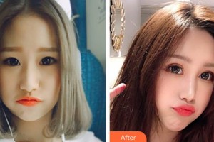 南方醫(yī)院整形美容科劉曉軍整形價格表附射頻緊膚案例展示