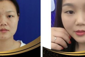 南方醫(yī)院整形美容科陳其慶住院醫(yī)師整形價格表附埋線提升案例展示