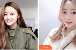 南方醫(yī)院整形美容科胡振富整形價格表附埋線提升案例展示