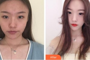 南方醫(yī)院整形美容科魯峰整形價格表附埋線提升案例展示