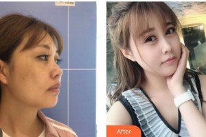 南方醫(yī)院整形美容科羅勇整形價格表附埋線提升案例展示