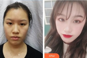 白求恩國際和平醫(yī)院整形美容中心楊建民整形價格表附埋線提升案例展示