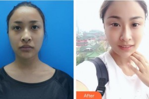 白求恩國際和平醫(yī)院整形美容中心李曉東整形價格表附埋線提升案例展示