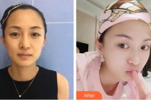 白求恩國際和平醫(yī)院整形美容中心王配合整形價格表附埋線提升案例展示