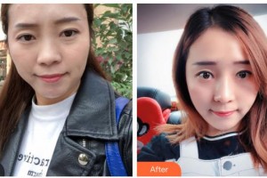 白求恩國際和平醫(yī)院整形美容中心王鵬整形價格表附埋線提升案例展示