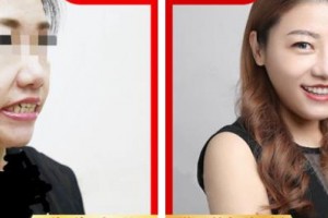 樂清牙科醫(yī)院許紅整形價格表附牙齒隱形矯正案例展示