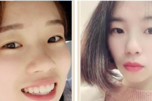 樂清市第三人民醫(yī)院眼科倪林云整形價格表附隱形托槽矯正案例展示