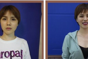 樂清牙科醫(yī)院劉經(jīng)輝整形價格表附美白貼片案例展示