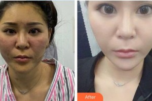 暨南大學(xué)附屬第一醫(yī)院整形美容激光中心李康英  整形價格表附牙齒陶瓷矯正案例展示