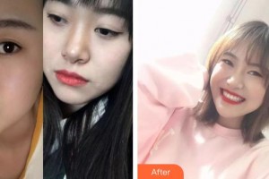 暨南大學(xué)附屬第一醫(yī)院整形美容激光中心肖麗玲整形價格表附金屬托槽矯正案例展示