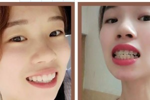 暨南大學(xué)附屬第一醫(yī)院整形美容激光中心謝波 整形價格表附牙齒隱形矯正案例展示