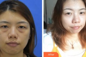 永康東方醫(yī)療美容診所馬聰整形價格表附激光去眼袋案例展示