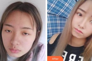 永康胡韻口腔門診部楊玲燕整形價格表附切開雙眼皮案例展示