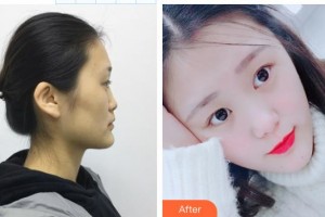 清遠養(yǎng)和整形美容醫(yī)院余嬌整形價格表附鼻部綜合案例展示
