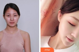 清遠養(yǎng)和整形美容醫(yī)院徐新星整形價格表附鼻部綜合案例展示