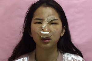 無錫人民醫(yī)院皮膚美容科隆鼻附果圖+2021價(jià)格表