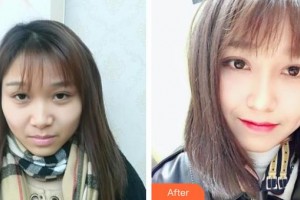 南華大學附屬第二醫(yī)院醫(yī)療美容科劉志坤整形價格表附鼻部綜合案例展示