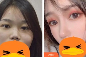 南華大學附屬第二醫(yī)院醫(yī)療美容科肖霞整形價格表附鼻部綜合案例展示