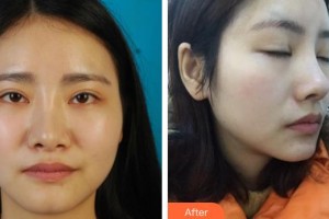 佛山曙光金子醫(yī)學美容醫(yī)院王業(yè)勝整形價格表附鼻部綜合案例展示