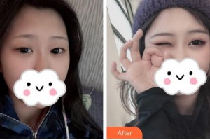 佛山華廈眼科醫(yī)院朱天倫整形價格表附眼部綜合案例展示