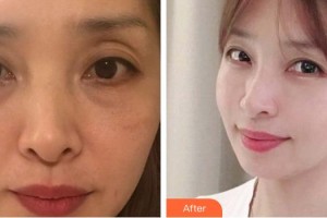 佛山華廈眼科醫(yī)院張弛整形價(jià)格表附眼部綜合案例展示