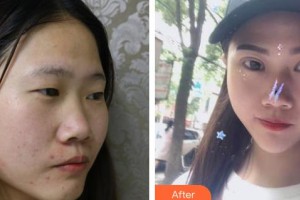 佛山新容奇醫(yī)院眼科胡小成整形價格表附切開雙眼皮案例展示