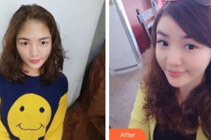 佛山華廈眼科醫(yī)院余建洪整形價格表附埋線雙眼皮案例展示