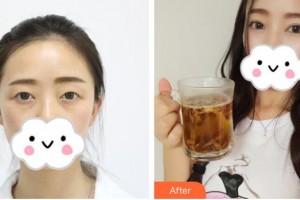 佛山華廈眼科醫(yī)院張廣斌整形價(jià)格表附切開(kāi)雙眼皮案例展示