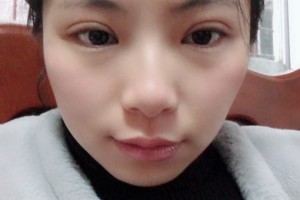 上海南山整容醫(yī)院割雙眼皮手術(shù)案例分享附價格表