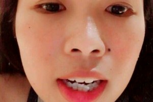 石家莊中諾口腔醫(yī)院口碑怎么樣牙齒矯正日記分享