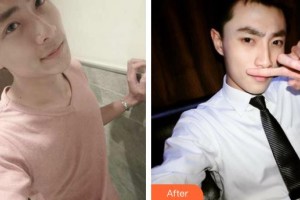 武夷山麗姿醫(yī)療美容醫(yī)院樸炳春整形價(jià)格表附鼻部綜合案例展示