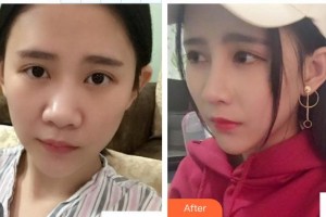 皖北煤電集團(tuán)總醫(yī)院醫(yī)學(xué)美容中心朱曉云整形價(jià)格表附鼻部綜合案例展示