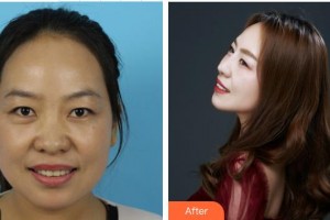 皖北煤電集團(tuán)總醫(yī)院醫(yī)學(xué)美容中心盛瑋潔住院醫(yī)師整形價(jià)格表附耳軟骨復(fù)合隆鼻案例展示