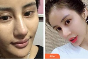 黃河中心醫(yī)院整形美容中心王磊整形價(jià)格表附鼻部綜合案例展示