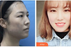 普寧伊麗莎白醫(yī)療美容診所李鐵軍整形價(jià)格表附眼部手術(shù)案例展示