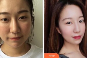 普寧市人民醫(yī)院眼科方曉珊整形價(jià)格表附切開(kāi)雙眼皮案例展示