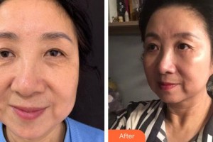 普寧市人民醫(yī)院眼科黃伯健整形價(jià)格表附內(nèi)切祛眼袋案例展示