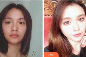 普寧市人民醫(yī)院眼科張建珠整形價(jià)格表附切開(kāi)雙眼皮案例展示